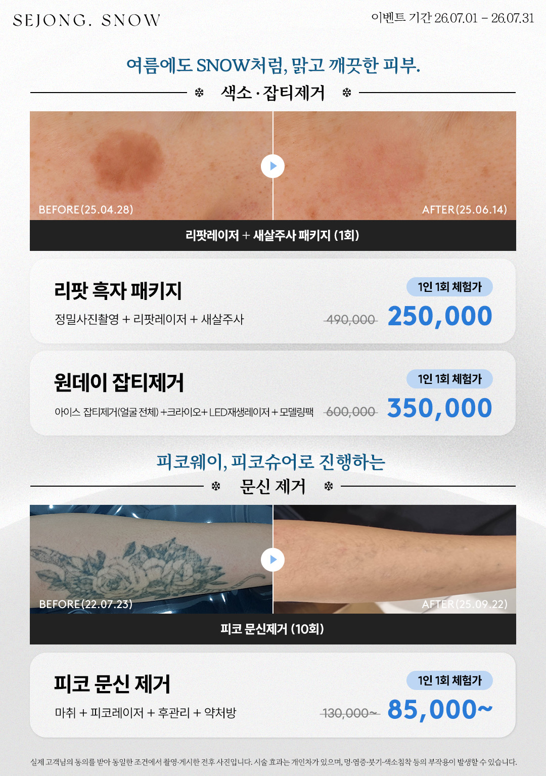 흑자/점/문신제거